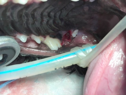 虫歯 (3)