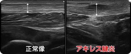 踵の痛み・アキレス腱の痛み・治療・京都