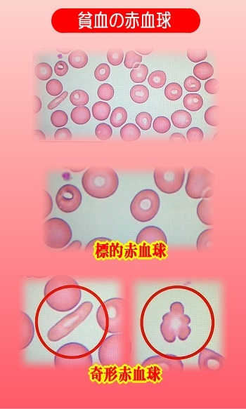 貧血の赤血球