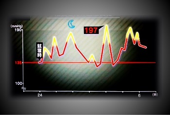 睡眠中の血圧サージ