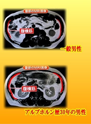 体幹 腹部のMRI画像